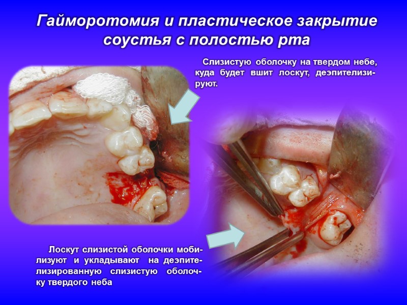 Гайморотомия и пластическое закрытие соустья с полостью рта     Слизистую оболочку